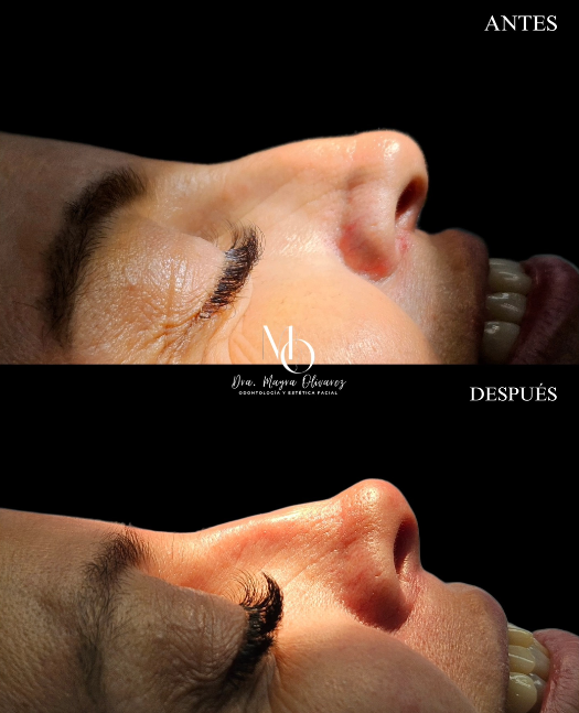 Perfilación nasal